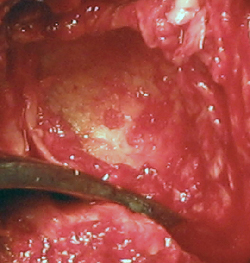 Glenoid with chondrolysis