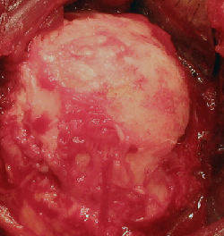 Humeral head with chondrolysis