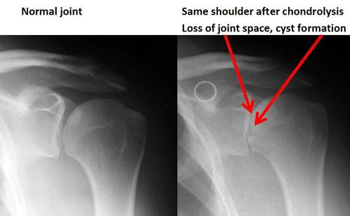 Treatment of shoulder chondrolysis