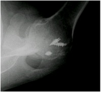 Axillary View