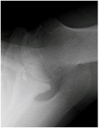 Axillary View