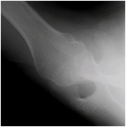 Axillary View