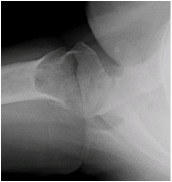 Axillary View