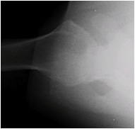 Axillary View