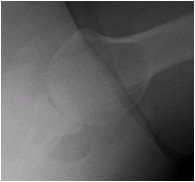 Axillary View
