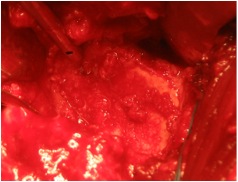 Glenoid