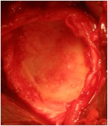 Glenoid