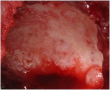 Glenoid