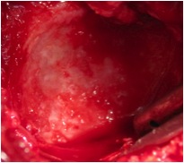 Glenoid
