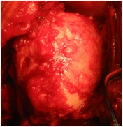 Humeral Head
