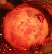 Humeral Head