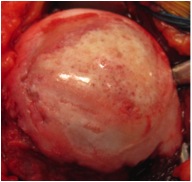 Humeral Head