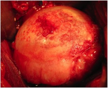 Humeral Head