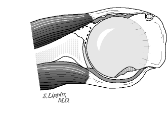 Figure 2 - Deficiency of the rim of the glenoid socket: Repeated dislocations can wear away the front lip of the socket of the shoulder Figure 2 - Deficiency of the rim of the glenoid socket: Repeated dislocations can wear away the front lip of the socket of the shoulder