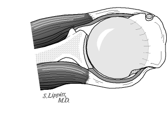 Figure 3 - Previous fracture of the lip of the socket: A previous fracture of the rim of the glenoid socket lessens its ability to stabilize the head of the humerus