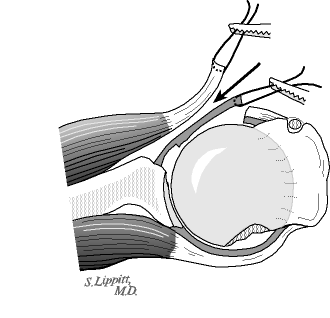Figure 4 - Separating the subscapularis tendon from the underlying capsule provides access to the site where the graft will be placed