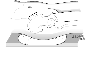Figure 5 - The graft is harvested from the iliac rest (hip beltline) on the same side as the shoulder reconstruction