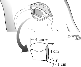 Figure 6 - The bone graft is taken from the upper outer aspect of the iliac crest at the beltline. After the harvest the muscle attachments are repaired.