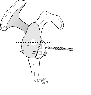 Figure 7 - Drilling and then screwing the graft to the glenoid provides firm fixation in the desired location