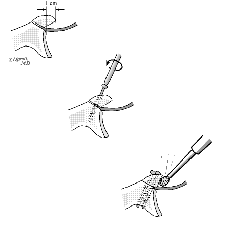 Figure 8 - Extra capsular graft placement: Screw fixation of the graft outside the capsule allows the capsule to protect the humeral head from the graft. Once fixed in position the graft can be finely contoured.
