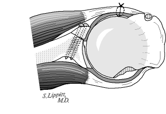 Figure 8 - Extra capsular graft placement: Screw fixation of the graft outside the capsule allows the capsule to protect the humeral head from the graft. Once fixed in position the graft can be finely contoured.