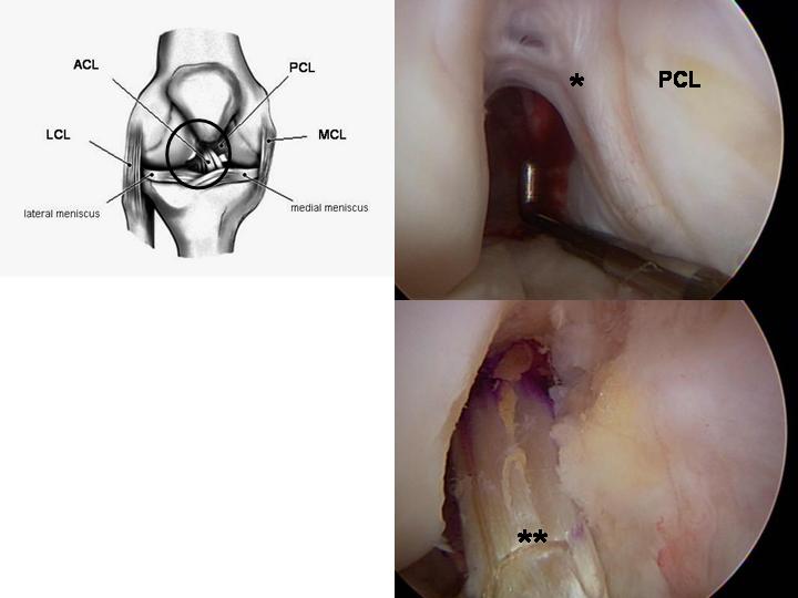 What is arthroscopy of the knee joint?