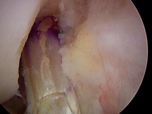 Does a patient feel pain after meniscus surgery?