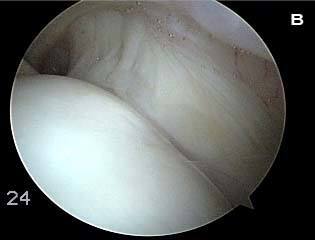 Figure 3b. Magnetic Resonance Imaging (MRI) of the rotator cuff and corresponding arthroscopic views. Views of shoulders in two different patients. The typical appearance of the rotator cuff in ?(A)? viewed through the arthroscope from below the cuff. The view is from the back of the shoulder joint looking forward.