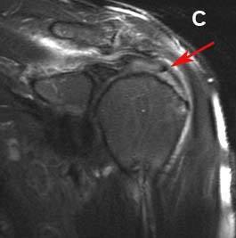 Figure 3c. Magnetic Resonance Imaging (MRI) of the rotator cuff and corresponding arthroscopic views. Views of shoulders in two different patients. MRI image of a moderately torn rotator cuff. The red arrow marks the torn edge of the rotator cuff, note the