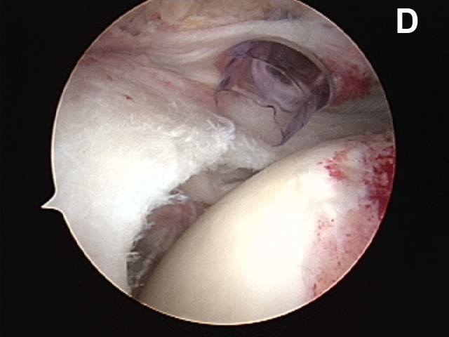 Figure 3d. Magnetic Resonance Imaging (MRI) of the rotator cuff and corresponding arthroscopic views. Views of shoulders in two different patients. The typical appearance of the torn cuff in ?(C)? as viewed through the arthroscope. This view is from above the cuff, looking down at the torn edge.