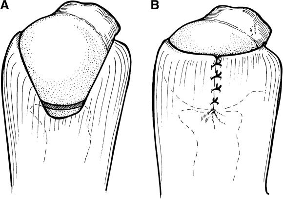 The margin convergence technique for rotator cuff repair. Views from above the shoulder before (A) and after (B) margin convergence.