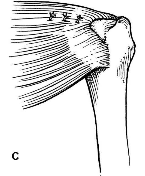 View from behind shoulder, showing the cuff after side-to-side repair before fixation to bone. (Redrawn from Burkhart SS. Arthroscopic treatment of massive rotator cuff tears. Clin Orthop, 390:107-118.)