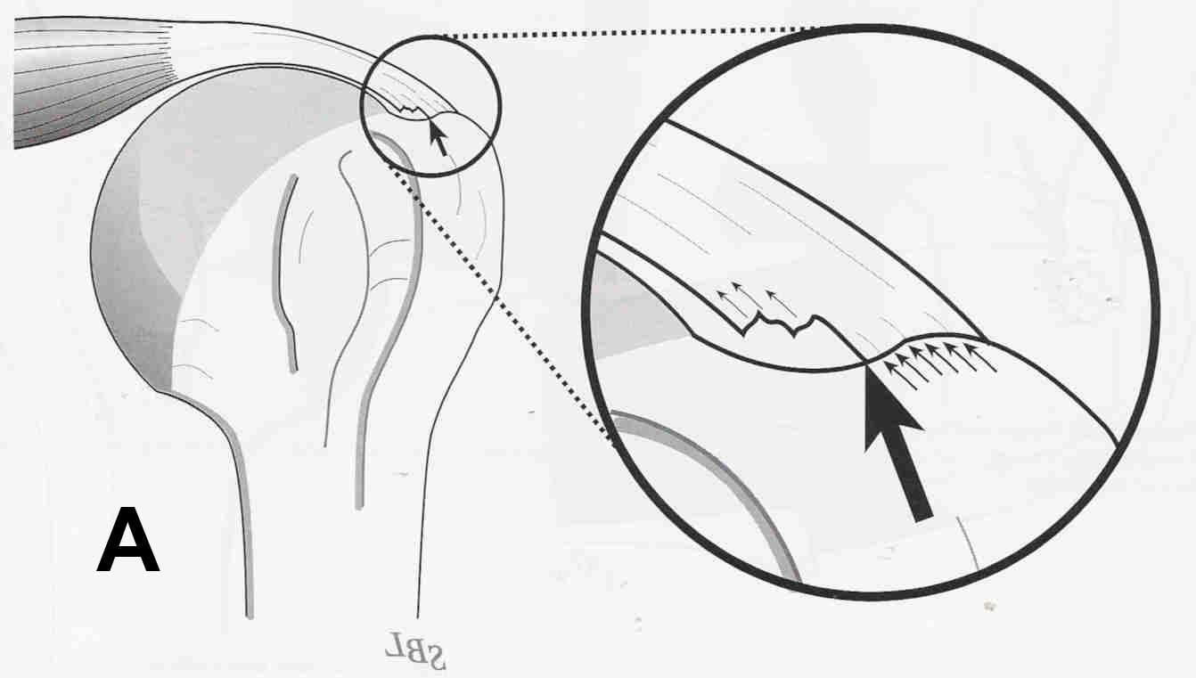 Figure 5a - Diagramatic (A) and arthroscopic (B) views of a partial thickness rotator cuff tear. (A) Rotator cuff tears usually begin as fraying of the deep fibers of the cuff as they insert at the bone of the humeral head (arrow).