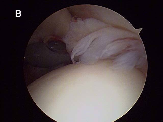 Figure 5b - Diagramatic (A) and arthroscopic (B) views of a partial thickness rotator cuff tear. An arthroscopic view of the frayed cuff insertion, as seen from the back of the joint looking forward. This is the same tear visualized in Video 1. (Diagram courtesy of Frederick A. Matsen, MD, redrawn from: Matsen FA and Lippitt SB. Shoulder Surgery: Principles and Procedures. Saunders, Philadelphia, 2004.)