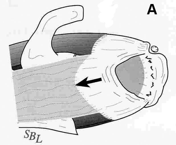 Figure 6. Diagramatic (A) and arthroscopic (B) views of a small- to medium-sized rotator cuff tear. (A) Shoulder as viewed from above. The arrow marks the tear ?pulling away? from the site it is normally attached to the right. (B) Arthroscopic view of a torn rotator cuff from above. The attachment site on the humeral head is visible to the lower right of the picture, the torn edge is in the middle of the picture. (Diagram courtesy of Frederick A. Matsen, MD, redrawn from: Matsen FA and Lippitt SB. Shoulder Surgery: Principles and Procedures. Saunders, Philadelphia, 2004.)