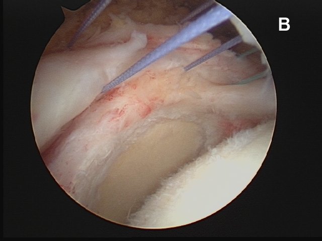 Figure 7b. Diagramatic (A) and arthroscopic (B) views of a massive, ?retracted? rotator cuff tear. (B) Arthroscopic view of a massive, retracted rotator cuff tear from above. The attachment site is out of the picture to the right, the glenoid socket is in view in the center of the picture. Blue sutures have been placed through the cuff edge, which must be used to repair the cuff by margin convergence and re-cover the humeral head (lower right of the photo). (Diagram courtesy of Frederick A. Matsen, MD, redrawn from: Matsen FA and Lippitt SB. Shoulder Surgery: Principles and Procedures. Saunders, Philadelphia, 2004.)