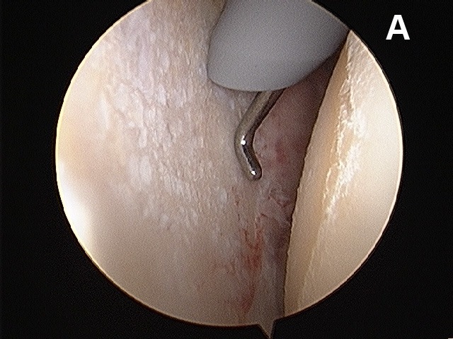 Figure 8a. Arthroscopic images of a severly arthritic shoulder joint. (A) A view from the rear of the joint looking forward. Note the complete loss of cartilage over the bone. The probe sits upon a bare bone glenoid surface with a completely worn cartilage surface. The humeral head is to the right of the picture.