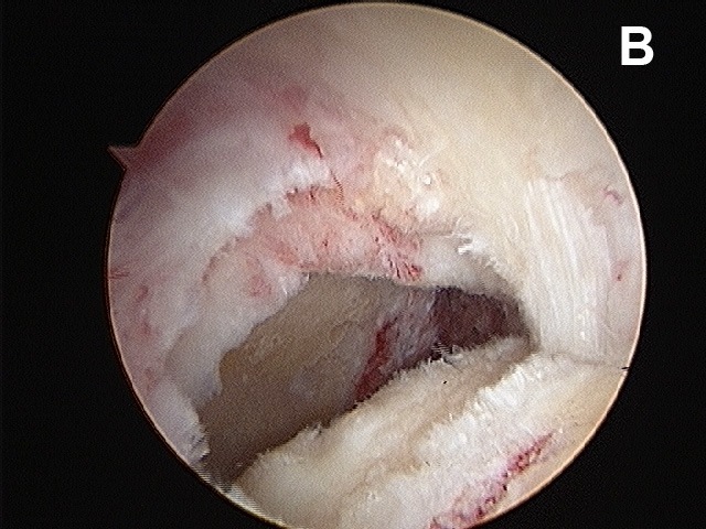Arthroscopic shoulder surgery for the treatment of rotator cuff tears