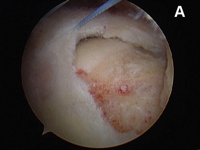 Figure 9a. Arthroscopic views of the repair of small to medium-sized rotator cuff tears. (A) A cuff tear as visualized from above.