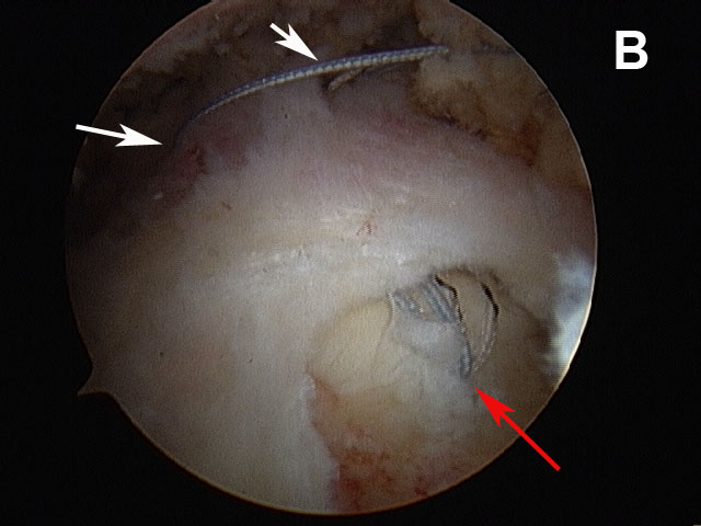 Figure 9b. Arthroscopic views of the repair of small to medium-sized rotator cuff tears. (B) A suture anchor has been placed in the bone at the rotator cuff attachment (red arrow), and the sutures have been brought out through the torn cuff edge (white arrows).