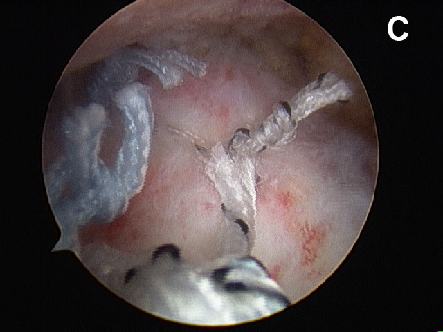 Figure 9c. Arthroscopic views of the repair of small to medium-sized rotator cuff tears. (C) The completed rotator cuff repair. The joint is no longer visible from above the rotator cuff.