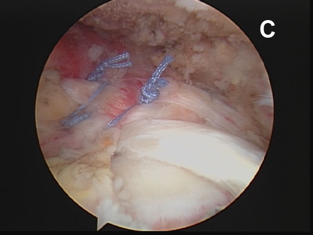 Figure 10 - (C) As the sutures are tied, the rotator cuff is ?sewn shut? over the joint.
