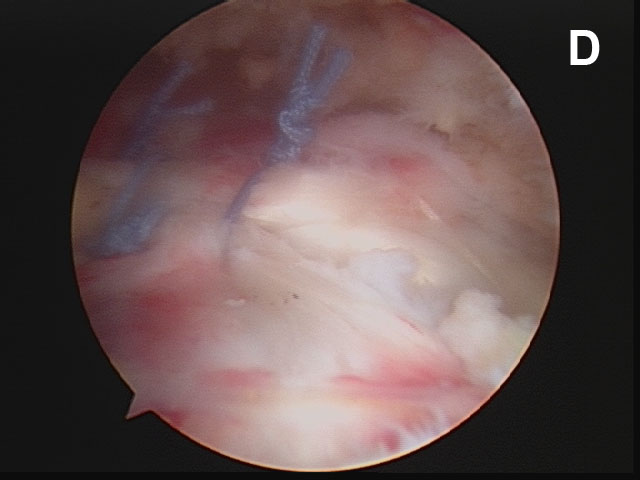 Figure 10 - (D) The completed cuff repair. Note that the joint surfaces are no longer visible.