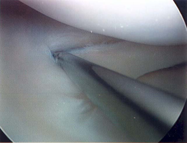 Arthroscopic view of repairable meniscus tear