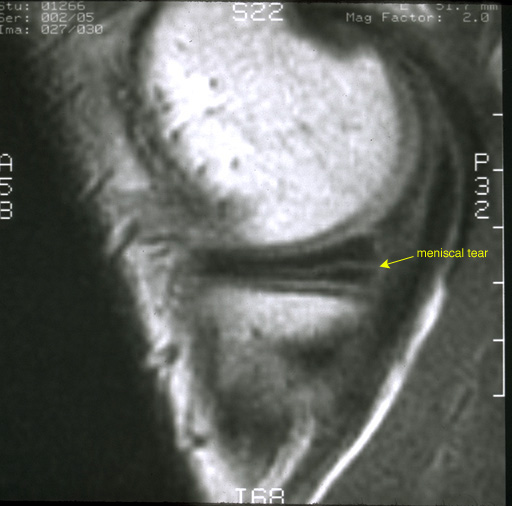 Arthroscopic Meniscectomy - MRI showing a torn meniscus