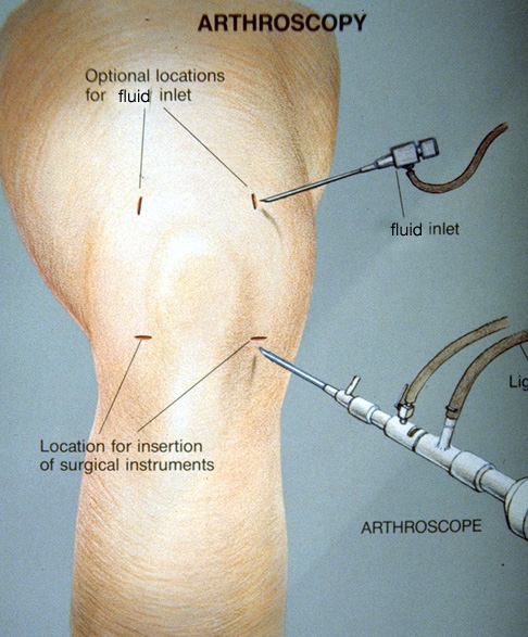 Arthroscopic Meniscectomy - Set-up for Arthroscopic Meniscectomy