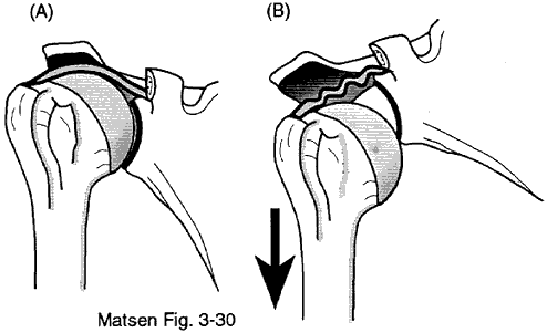 Figure 1 - Scapula drooping