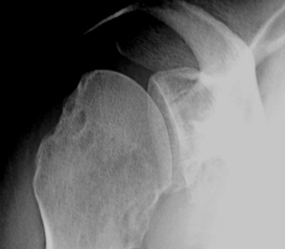 Bankart Repair for Unstable Dislocating Shoulders UW Orthopaedics and