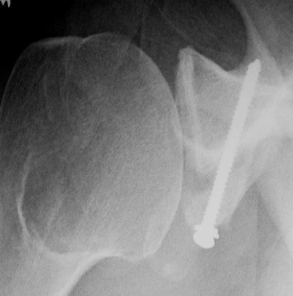 Bankart Repair for Unstable Dislocating Shoulders UW Orthopaedics and