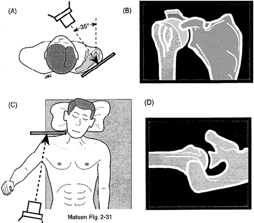 Figure 6 - Anteroposterior view in the plane of the scapula